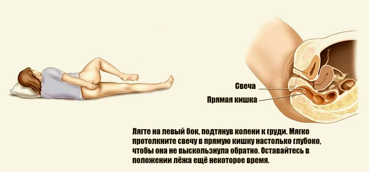 Введение свечи в прямую кишку