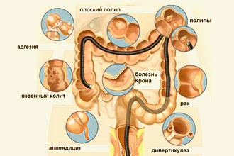 Какие болезни можно выявить с помощью колоноскопии