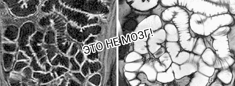 МРТ кишечника