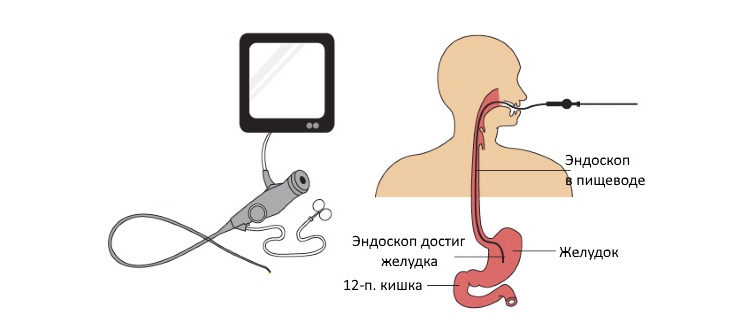 Схема проведения гастроскопии Схема проведения гастроскопии
