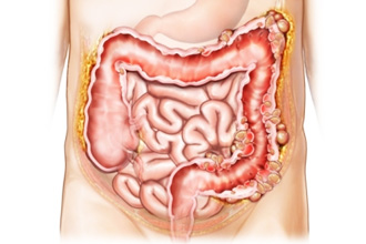 СРК - синдром раздраженного кишечника СРК - синдром раздраженного кишечника