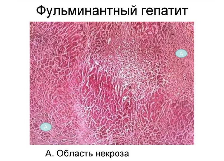 некроз гепатоцитов при фульминантном гепатите