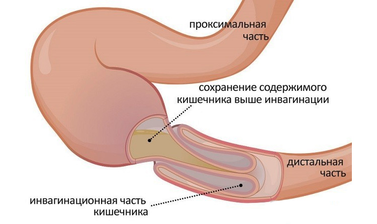 Механический вид непроходимости Механический вид непроходимости