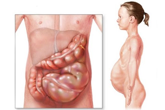 Вздутие живота может быть признаком формирования кишечной непроходимости Вздутие живота может быть признаком формирования кишечной непроходимости