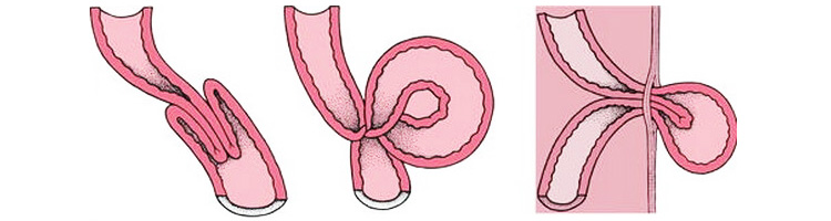 Острая кишечная непроходимость у ребенка - виды Острая кишечная непроходимость у ребенка