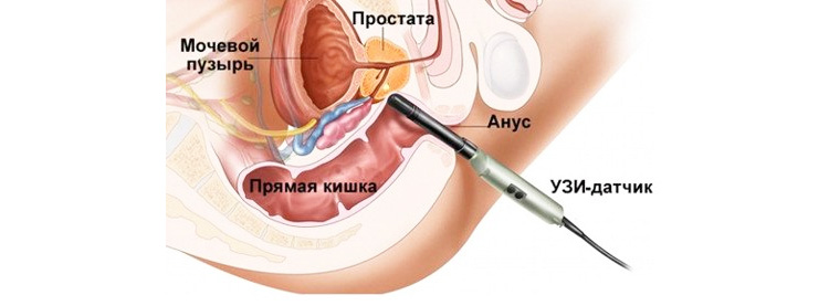 УЗИ малого таза УЗИ