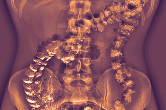 Что дает ирригоскопия