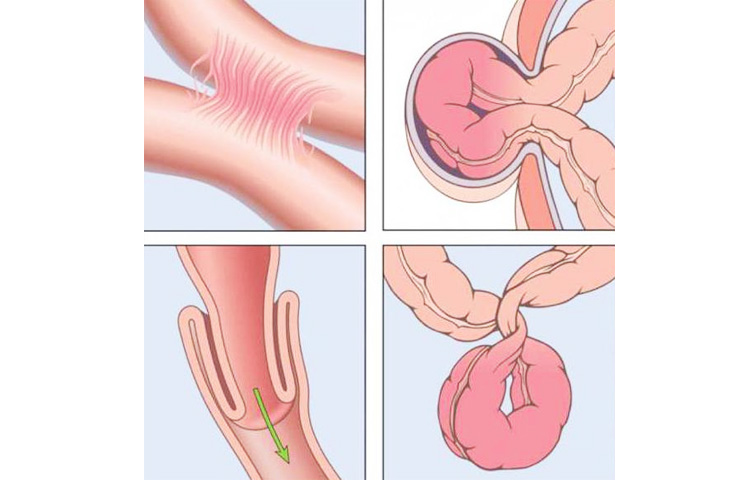 Виды кишечной непроходимости у пожилых людей Виды кишечной непроходимости у пожилых людей