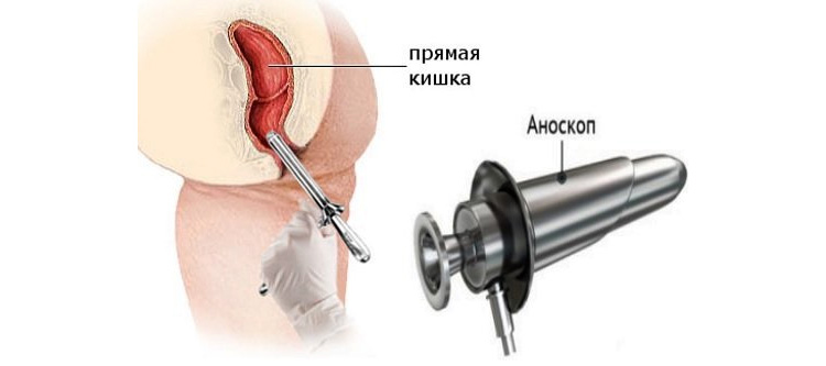 Аноскопия Аноскопия
