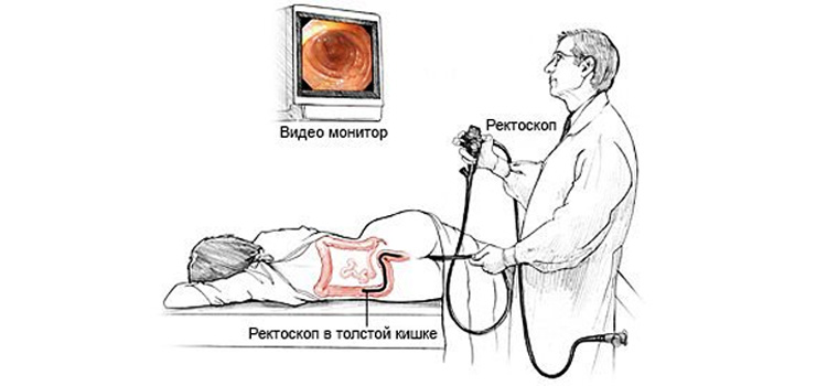 Ректороманоскопия Ректороманоскопия