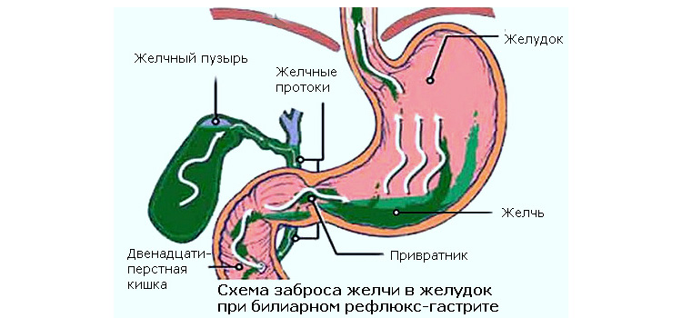 Заброс желчи в желудок при билиарном рефлюкс-гастрите Билиарный рефлюкс гастрит