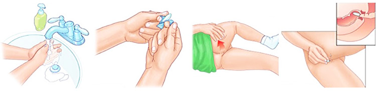 Постановка ректальной свечи Постановка ректальной свечи