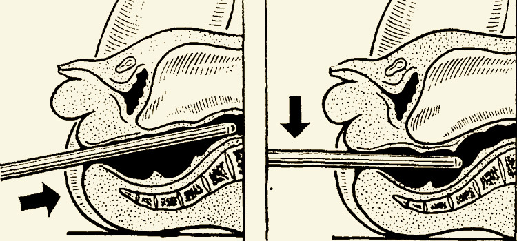 Как проводится ректороманоскопия