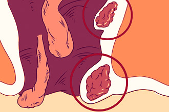 Что такое геморрой