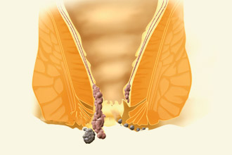 Появление геморроя после родов