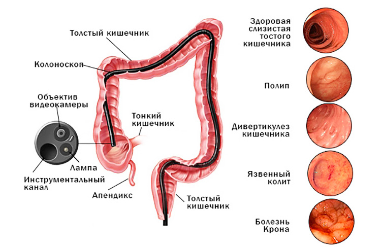 Колоноскопия Колоноскопия