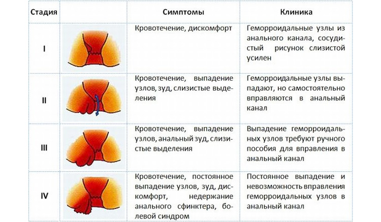 Геморрой является одним из факторов развития болевого синдрома Геморрой является одним из факторов развития болевого синдрома