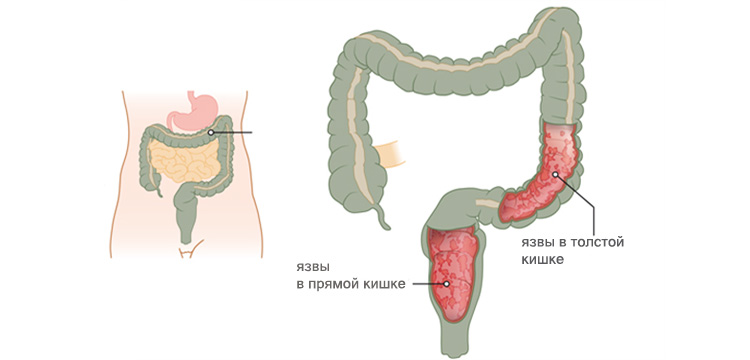 Неспецифический язвенный колит Неспецифический язвенный колит