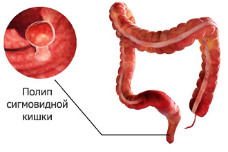 Полипы в сигмовидной кишке Полипы в сигмовидной кишке