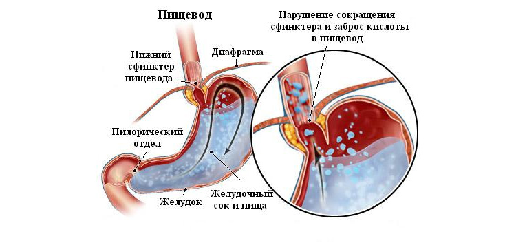Нарушение работы желудочной мускулатуры Нарушение работы желудочной мускулатуры