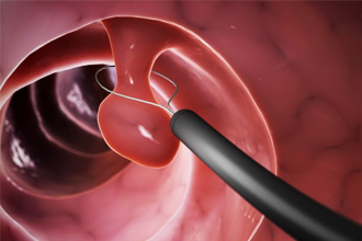 Проведение полипэктомии Проведение полипэктомии