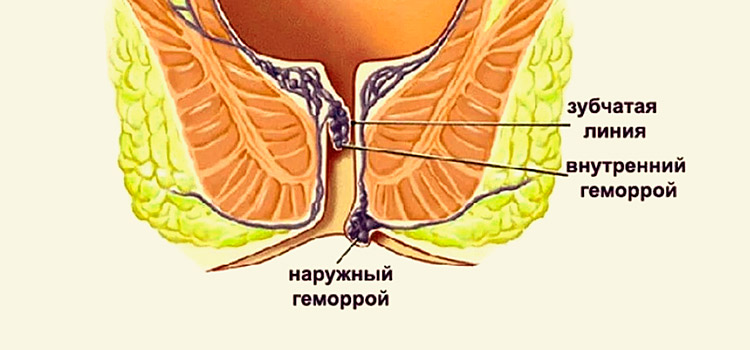 Виды геморроя