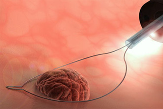 Полипэктомия Полипэктомия