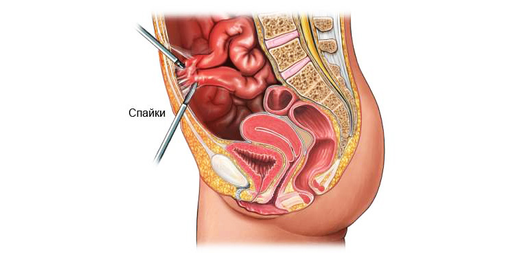 Спайки кишечника Спайки кишечника