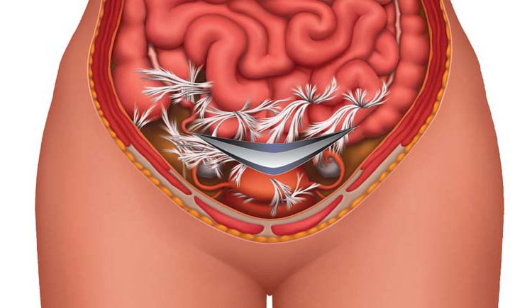 Спайки кишечника Спайки кишечника