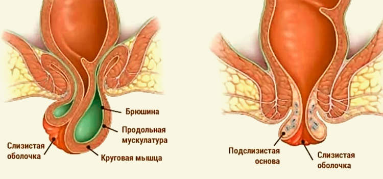 Схема геморроидальных узлов
