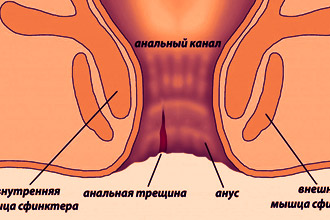 Рисунок геморроя