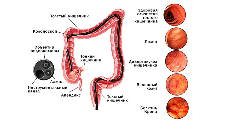 Колоноскопия Колоноскопия