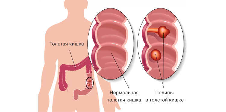 Полипы в толстой кишке Полипы в толстой кишке