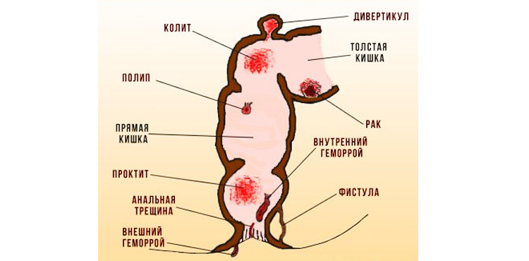 Возможные причины кровотечения из прямой кишки Возможные причины кровотечения из прямой кишки