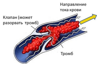 Тромб Тромб