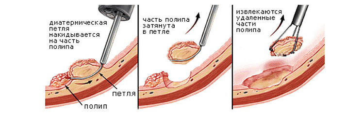 Хирургическое удаление полипов Хирургическое удаление полипов