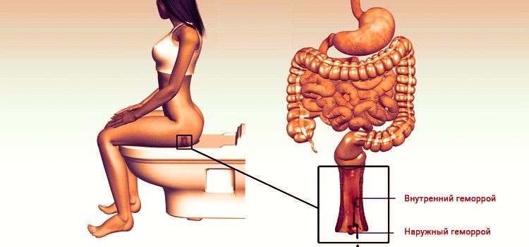Симптомы геморроя и прием Венорус и Детралекс