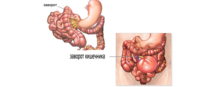 Перекрут петель кишечника Перекрут петель кишечника
