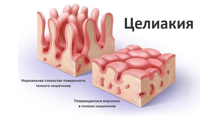 Целиакия Целиакия