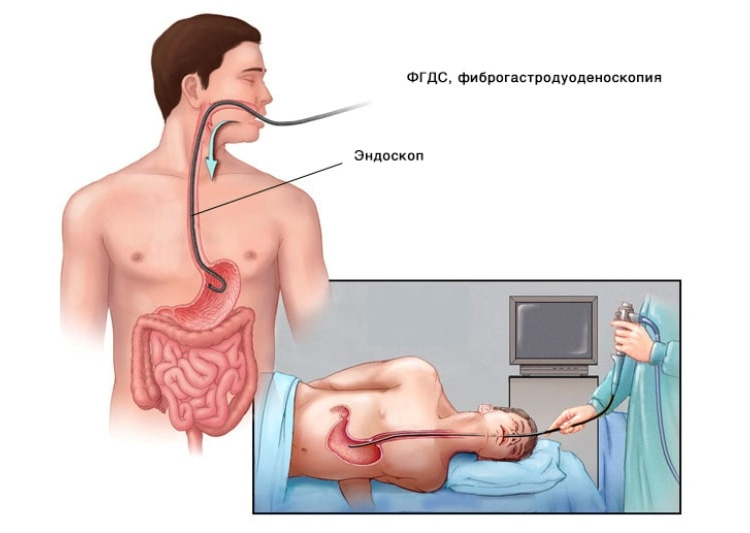 Что такое фиброгастродуоденоскопия? Фиброгастродуоденоскопия